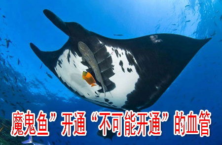 魔鬼魚(yú)”開(kāi)通“不可能開(kāi)通”的血管