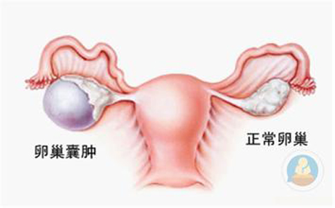 卵巢囊腫，抱腿壓涌泉穴，給你愛心呵護(hù)
