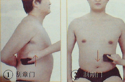胃、十二指腸潰瘍—刮痧